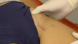 Ultrasound Guided Subacromial Bursal injection [upl. by Funda537]