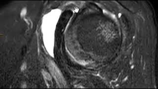 AOA Orthopedic Specialists  Subacromial Bursitis [upl. by Ylrebme261]