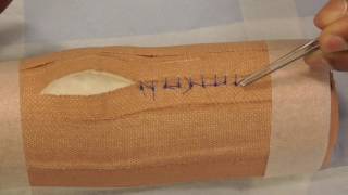 Suture Removal  simple interrupted [upl. by Vig715]