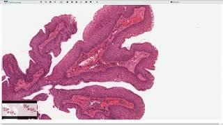 Squamous Papilloma  Larynx  Histopathology [upl. by Rebane42]