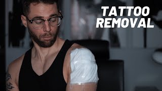 My Laser Tattoo Removal Experience  UPPER ARM Pain Cost and WHY Im removing it [upl. by Deming]