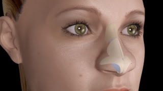 Bulbous Large Nasal Tip Nose Job Rhinoplasty [upl. by Aihsekel303]