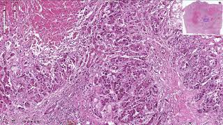 Hepatocellular Carcinoma  Histopathology [upl. by Inavoy]