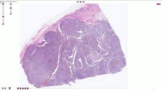 Papillary Renal Cell Carcinoma  Histopathology [upl. by Boylston]