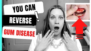 How to Reverse Gum Disease at Home [upl. by Scottie]