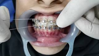 Orthodontic Ligation [upl. by Valma]