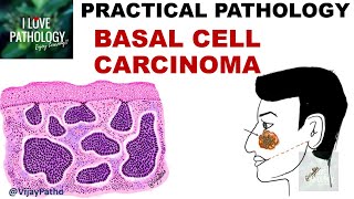 BASAL CELL CARCINOMA Clinical features amp Morphology [upl. by Attelrak]