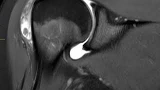 Rotator Cuff tear Imaging  Everything You Need To Know  Dr Nabil Ebraheim [upl. by Saw]