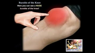 How To Cure Your Shoulder Tendonitis Bursitis amp Impingement [upl. by Ecile108]