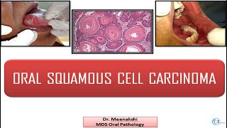 Oral Squamous Cell Carcinoma [upl. by Llenyaj249]