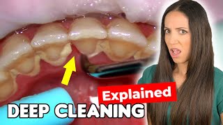 Dental Hygienist Explains Deep Cleaning Procedure [upl. by Phio]