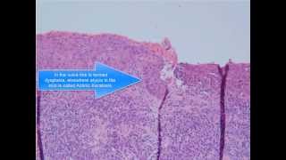 Squamous Cell Carcinoma [upl. by Gisella]