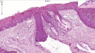 HSIL  High Grade Squamous Intraepithelial Lesion  Histopathology [upl. by Hallette799]