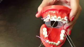 Placing a stainless steel ligature wire for Braces [upl. by Annissa]