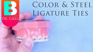 BRACES EXPLAINED Color and Steel Ligature Ties [upl. by Ahsirhcal]